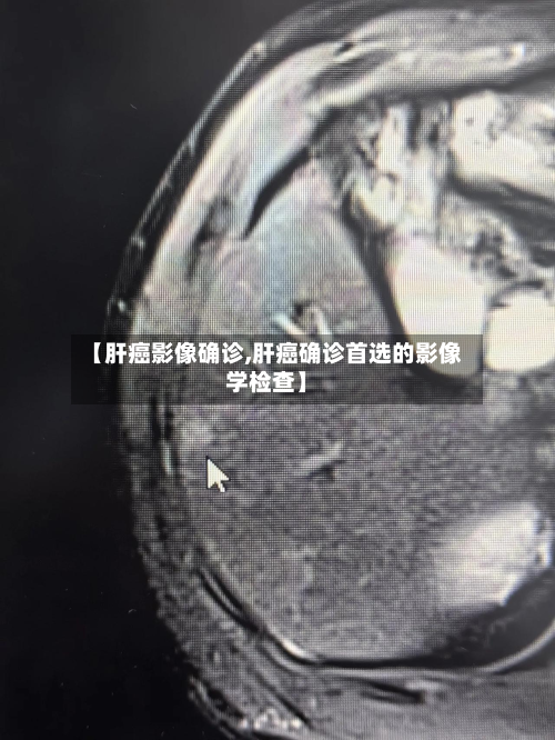 【肝癌影像确诊,肝癌确诊首选的影像学检查】