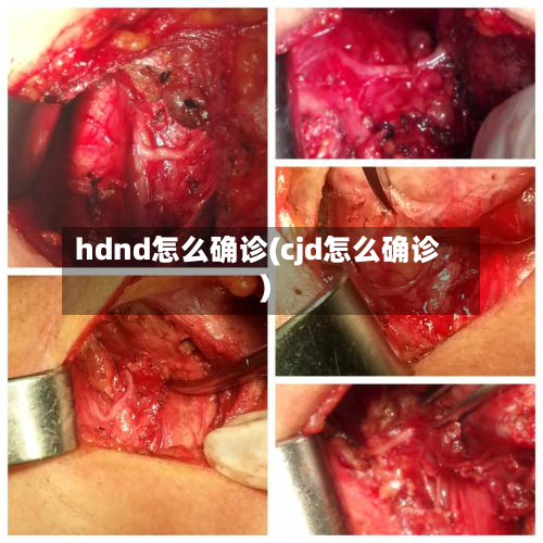hdnd怎么确诊(cjd怎么确诊)