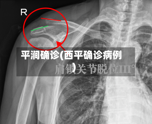 平涧确诊(西平确诊病例)-第2张图片
