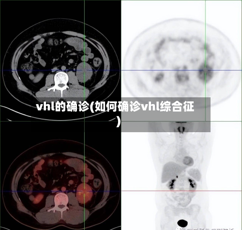 vhl的确诊(如何确诊vhl综合征)