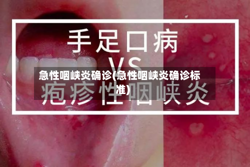 急性咽峡炎确诊(急性咽峡炎确诊标准)