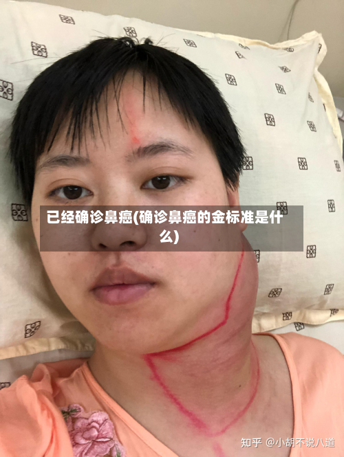 已经确诊鼻癌(确诊鼻癌的金标准是什么)-第2张图片