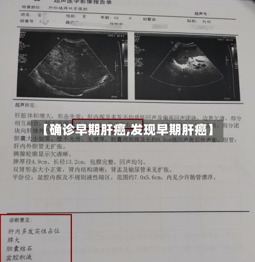 【确诊早期肝癌,发现早期肝癌】