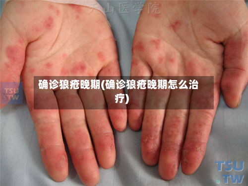 确诊狼疮晚期(确诊狼疮晚期怎么治疗)-第3张图片