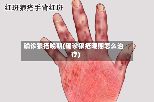 确诊狼疮晚期(确诊狼疮晚期怎么治疗)-第2张图片