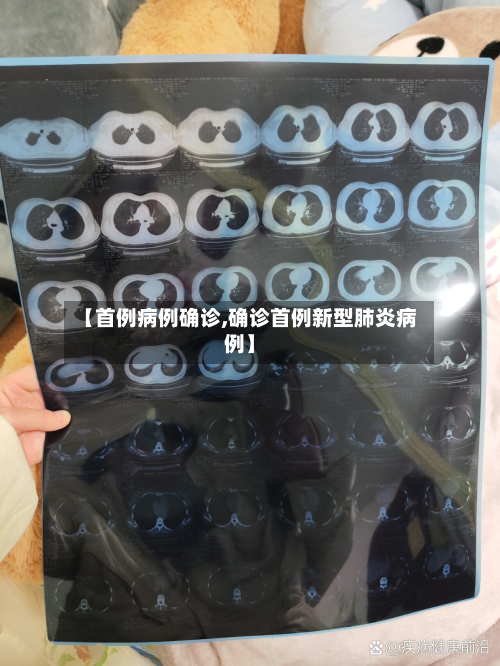 【首例病例确诊,确诊首例新型肺炎病例】