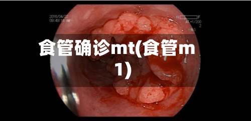 食管确诊mt(食管m1)-第2张图片