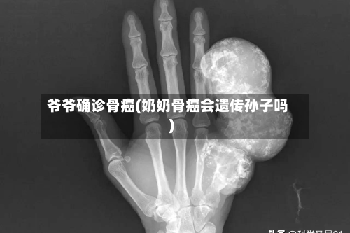 爷爷确诊骨癌(奶奶骨癌会遗传孙子吗)