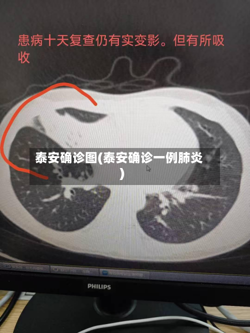泰安确诊图(泰安确诊一例肺炎)