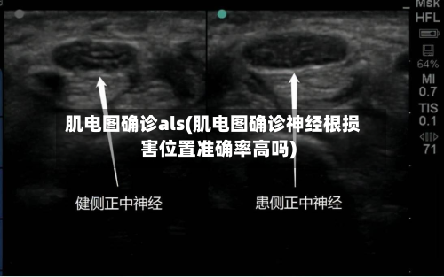 肌电图确诊als(肌电图确诊神经根损害位置准确率高吗)