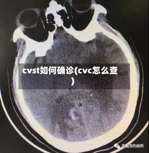 cvst如何确诊(cvc怎么查)-第2张图片