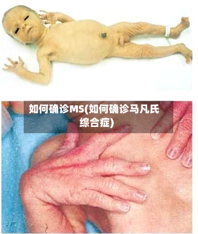 如何确诊MS(如何确诊马凡氏综合症)