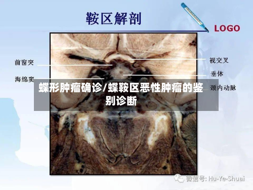 蝶形肿瘤确诊/蝶鞍区恶性肿瘤的鉴别诊断-第2张图片