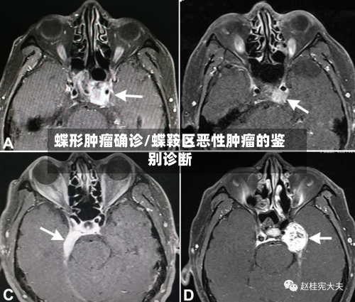 蝶形肿瘤确诊/蝶鞍区恶性肿瘤的鉴别诊断