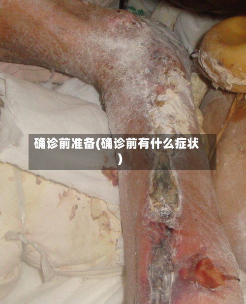 确诊前准备(确诊前有什么症状)-第2张图片
