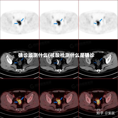 确诊监测什么(核酸检测什么是确诊)-第2张图片