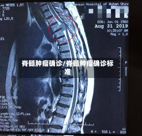 脊髓肿瘤确诊/脊髓肿瘤确诊标准-第2张图片