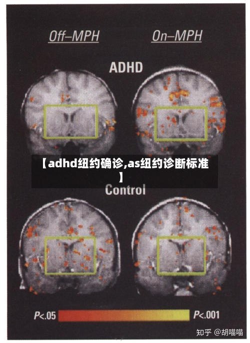 【adhd纽约确诊,as纽约诊断标准】-第2张图片