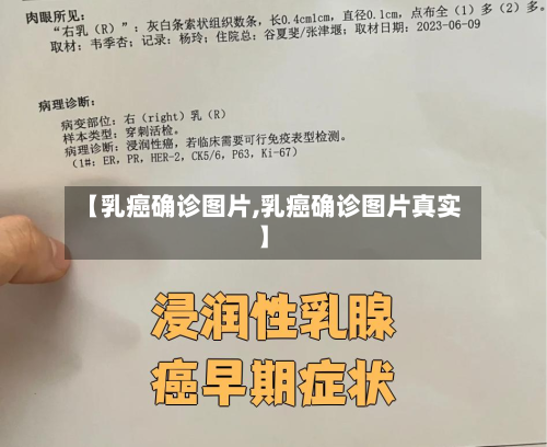 【乳癌确诊图片,乳癌确诊图片真实】