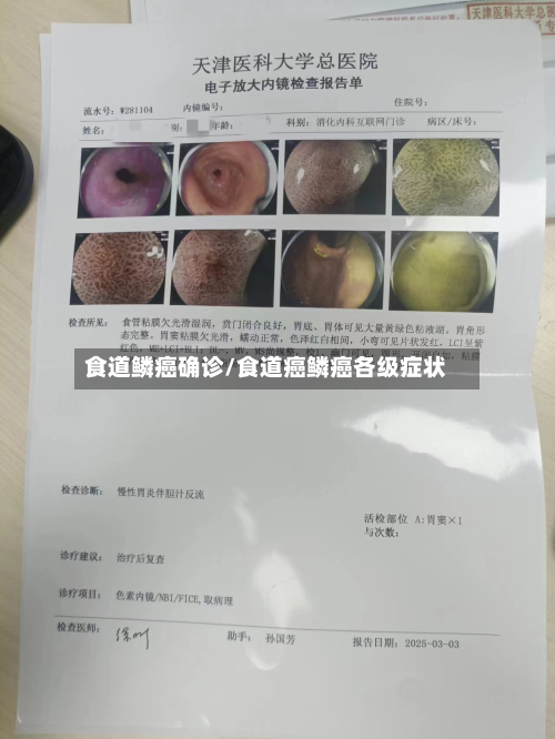 食道鳞癌确诊/食道癌鳞癌各级症状-第2张图片