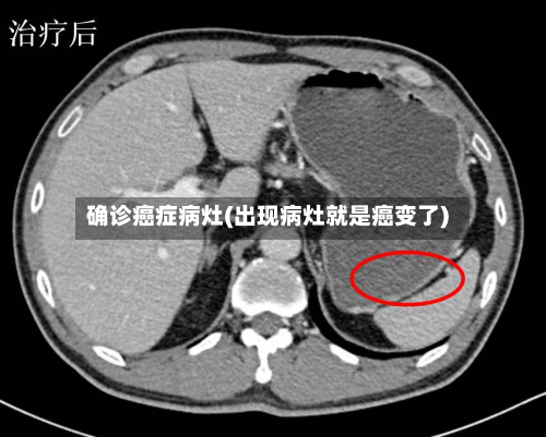 确诊癌症病灶(出现病灶就是癌变了)