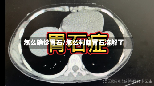 怎么确诊胃石/怎么判断胃石溶解了