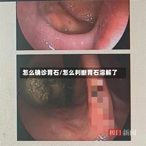 怎么确诊胃石/怎么判断胃石溶解了-第3张图片