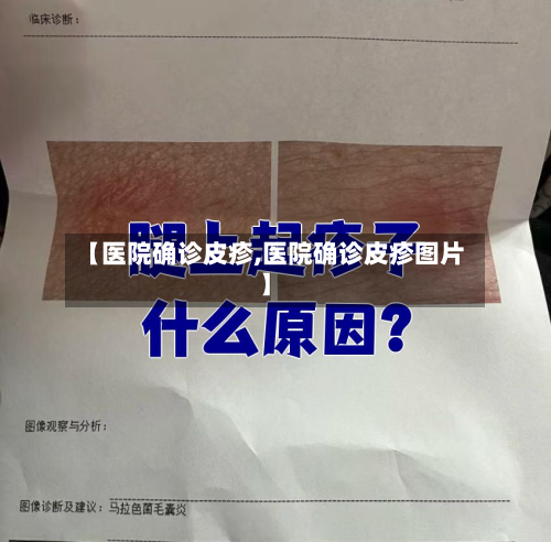 【医院确诊皮疹,医院确诊皮疹图片】