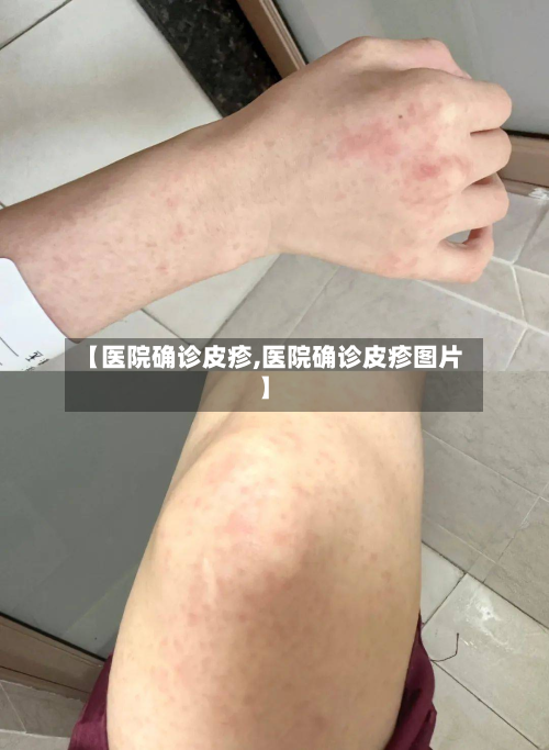 【医院确诊皮疹,医院确诊皮疹图片】-第2张图片