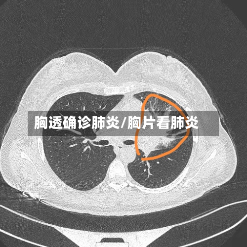 胸透确诊肺炎/胸片看肺炎