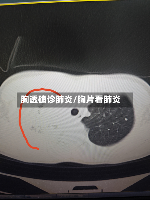 胸透确诊肺炎/胸片看肺炎-第3张图片