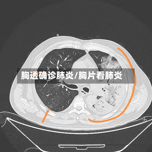 胸透确诊肺炎/胸片看肺炎-第2张图片