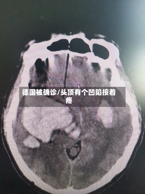 德国被确诊/头顶有个凹陷按着疼-第2张图片
