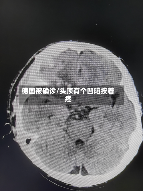 德国被确诊/头顶有个凹陷按着疼