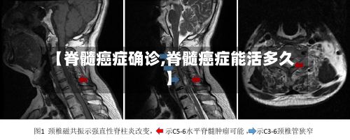 【脊髓癌症确诊,脊髓癌症能活多久】-第2张图片