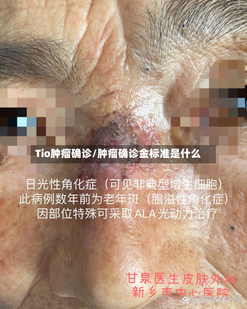 Tio肿瘤确诊/肿瘤确诊金标准是什么-第2张图片