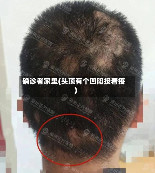 确诊者家里(头顶有个凹陷按着疼)-第2张图片