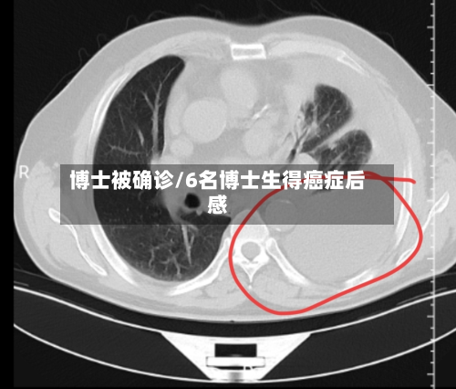 博士被确诊/6名博士生得癌症后感