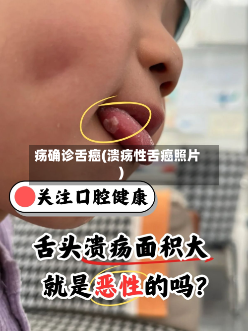 疡确诊舌癌(溃疡性舌癌照片)
