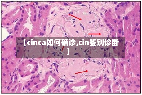 【cinca如何确诊,cin鉴别诊断】-第3张图片