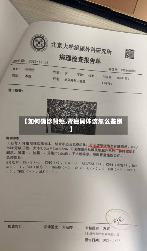 【如何确诊肾癌,肾癌具体该怎么鉴别】-第3张图片