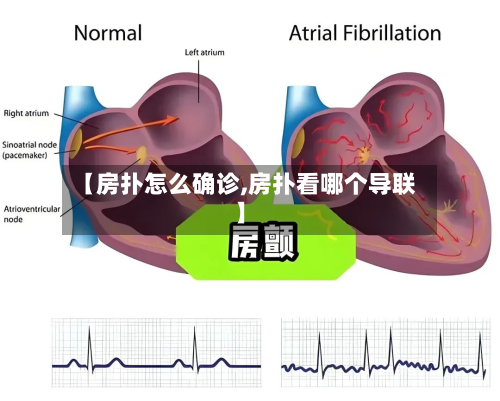 【房扑怎么确诊,房扑看哪个导联】