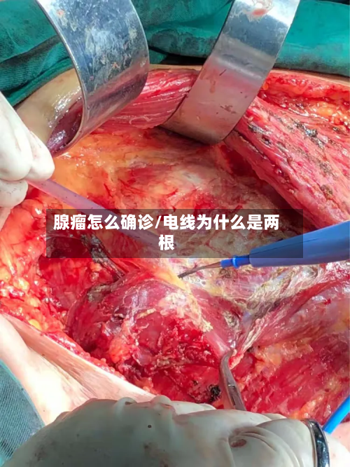腺瘤怎么确诊/电线为什么是两根