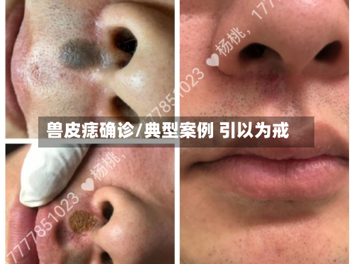 兽皮痣确诊/典型案例 引以为戒-第2张图片