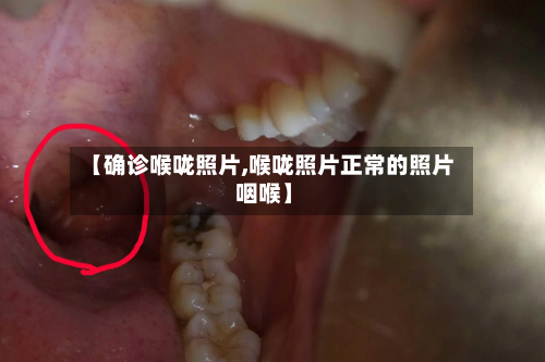 【确诊喉咙照片,喉咙照片正常的照片 咽喉】-第2张图片
