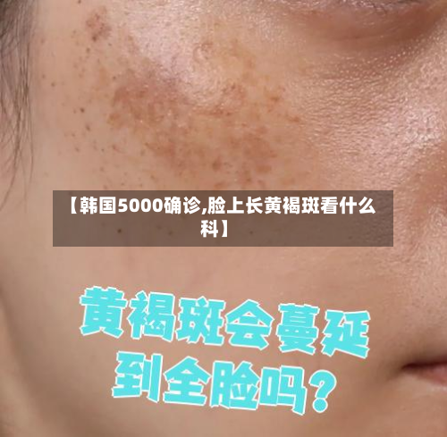 【韩国5000确诊,脸上长黄褐斑看什么科】-第3张图片