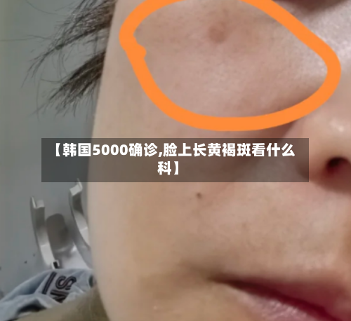 【韩国5000确诊,脸上长黄褐斑看什么科】