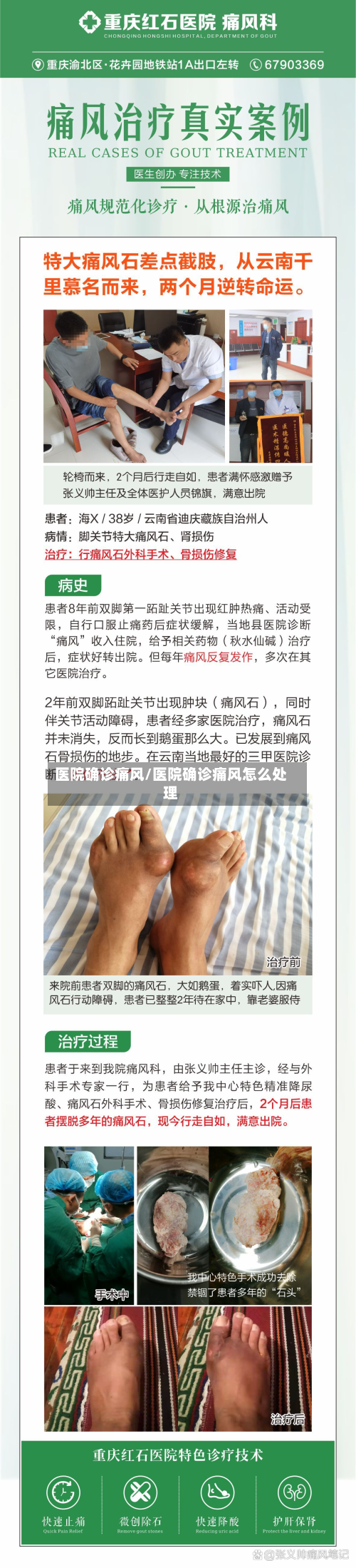 医院确诊痛风/医院确诊痛风怎么处理