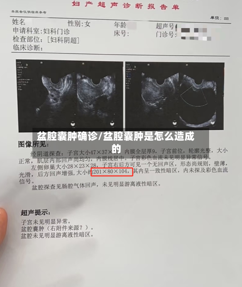 盆腔囊肿确诊/盆腔囊肿是怎么造成的
